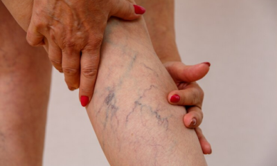 Spider Vein Treatment