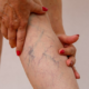 Spider Vein Treatment