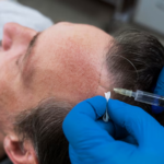 Tips for Maintaining Results After Hair Transplant