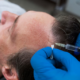 Hair Transplant