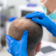 hair transplant