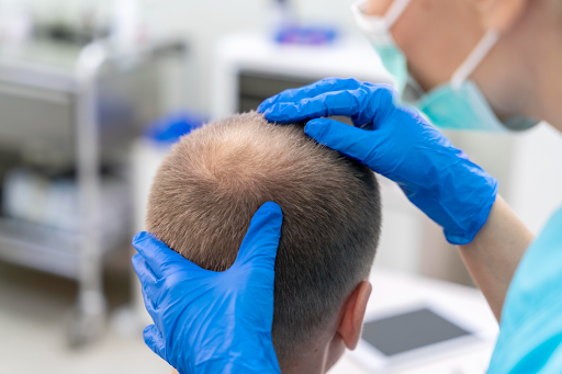 hair transplant