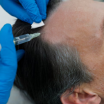 What Hair Type Responds Best to FUT or FUE