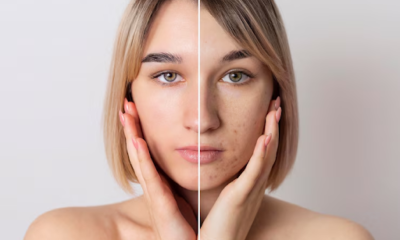 Dark Spot Treatment