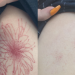How to Choose the Best Tattoo Removal Method for Your Ink