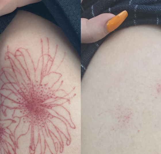 Tattoo Removal Method for Your Ink
