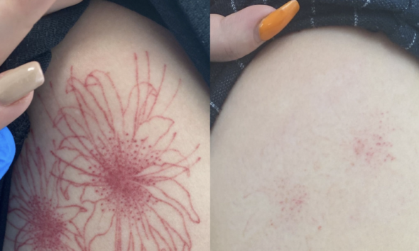 Tattoo Removal Method for Your Ink