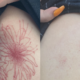 Tattoo Removal Method for Your Ink
