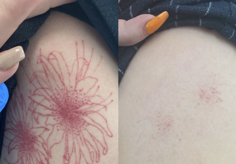 Tattoo Removal Method for Your Ink