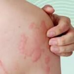 Why Self-Treating Rashes Can Backfire
