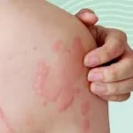Why Self-Treating Rashes Can Backfire