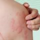Self-Treating Rashes