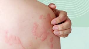 Self-Treating Rashes