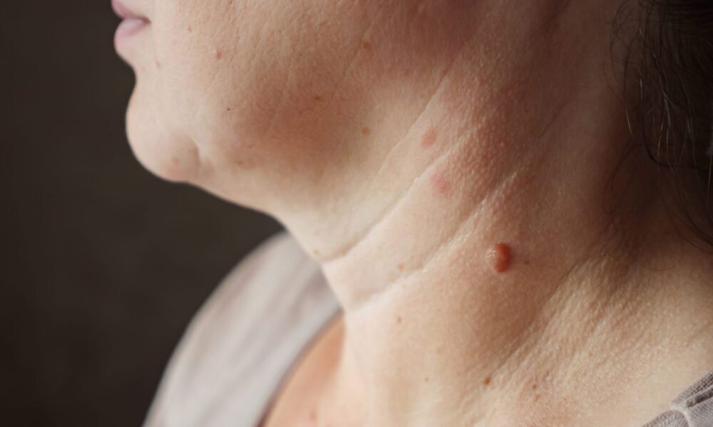 Warts