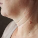 Can You Remove Warts Without a Doctor? Here’s How