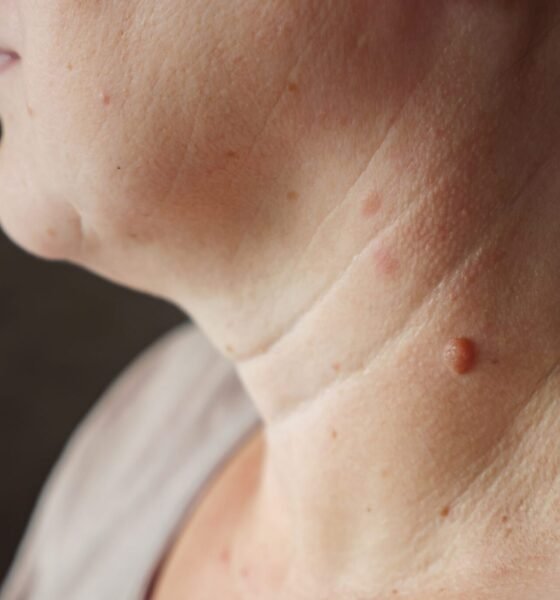 Warts