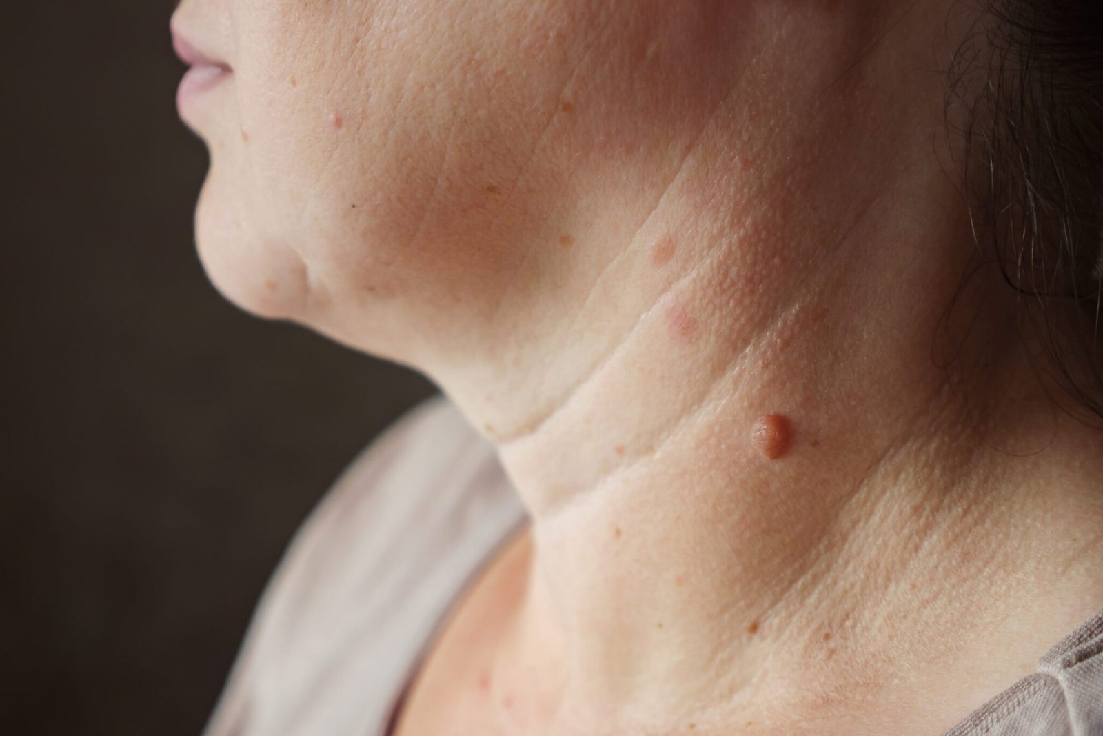 Warts